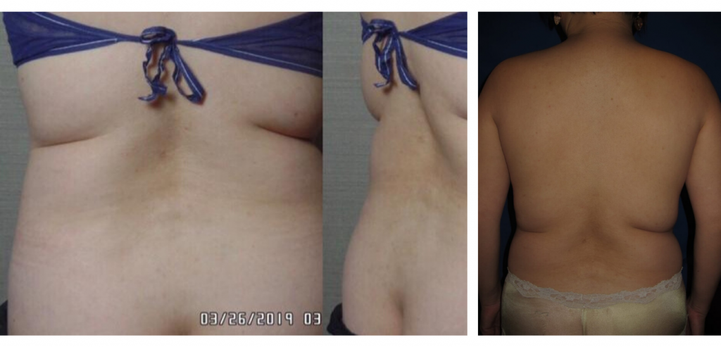 CoolSculpting PAH: The Paradoxical Adipose Hyperplasia Side Effect